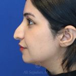 before rhinoplasty left side view female patient case 18286