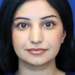 after rhinoplasty front view female patient case 18286