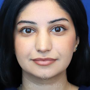 after rhinoplasty front view female patient case 18286