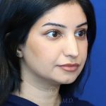 after rhinoplasty right view female patient case 18286