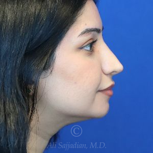 after rhinoplasty right side view female patient case 18286