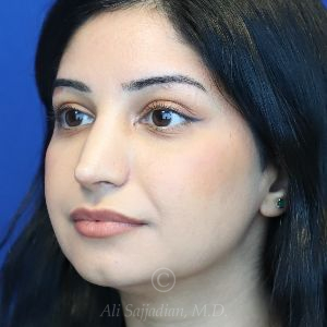 after rhinoplasty left view female patient case 18286