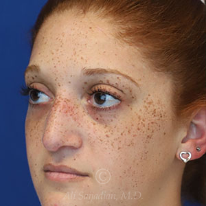 before rhinoplasty left view female patient case 18300