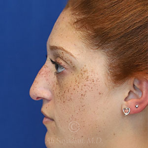 before rhinoplasty left side view female patient case 18300