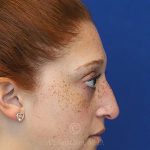 before rhinoplasty right side view female patient case 18300