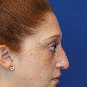 before rhinoplasty right side view female patient case 18300