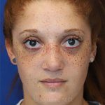 after rhinoplasty front view female patient case 18300