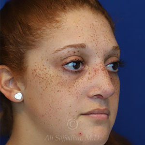 after rhinoplasty right view female patient case 18300