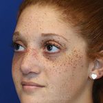 after rhinoplasty left view female patient case 18300