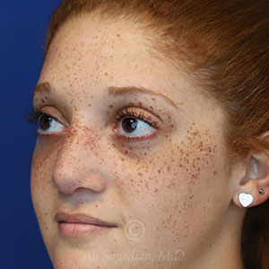 after rhinoplasty left view female patient case 18300