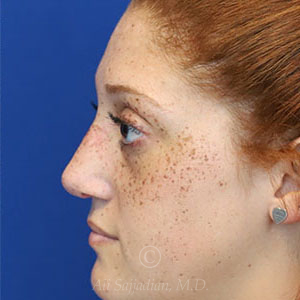 after rhinoplasty left side view female patient case 18300
