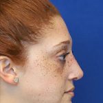 after rhinoplasty right side view female patient case 18300