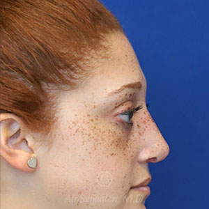 after rhinoplasty right side view female patient case 18300