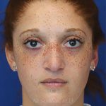 before rhinoplasty front view female patient case 18300