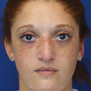 before rhinoplasty front view female patient case 18300
