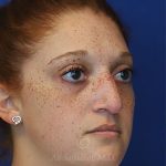before rhinoplasty right view female patient case 18300
