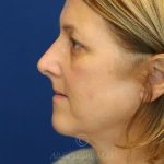 after rhinoplasty right side view female patient case 18311