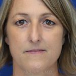 before rhinoplasty front view female patient case 18311