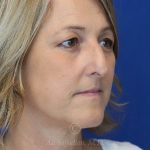 before rhinoplasty right view female patient case 18311