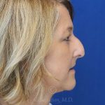 before rhinoplasty right side view female patient case 18311