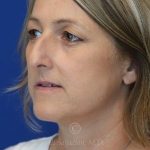 before rhinoplasty left view female patient case 18311