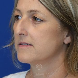 before rhinoplasty left view female patient case 18311