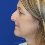 before rhinoplasty left side view female patient case 18311