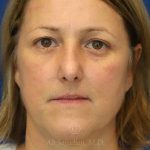after rhinoplasty front view female patient case 18311