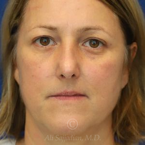 after rhinoplasty front view female patient case 18311