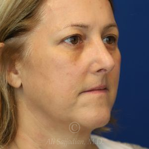after rhinoplasty right view female patient case 18311
