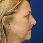 after rhinoplasty right side view female patient case 18311