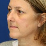 after rhinoplasty left view female patient case 18311