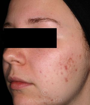 before aviclear right angle view female patient case 18405