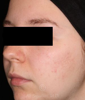 after aviclear right angle view female patient case 18405