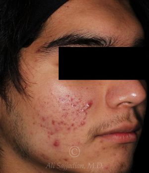 before aviclear right angle view male patient case 18408
