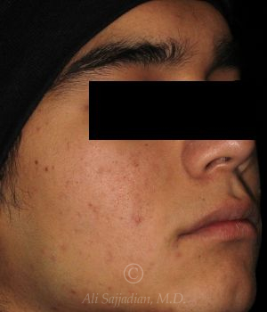 after aviclear right angle view male patient case 18408