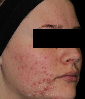 before aviclear right angle view female patient case 18414