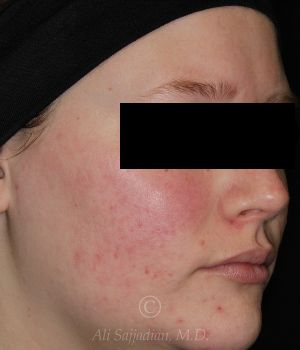 after aviclear right angle view female patient case 18414