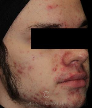 before aviclear right angle view male patient case 18417