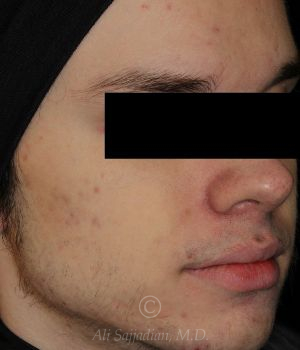 after aviclear right angle view male patient case 18417