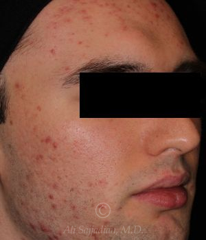 before aviclear right angle view male patient case 18420