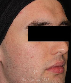 after aviclear right angle view male patient case 18420