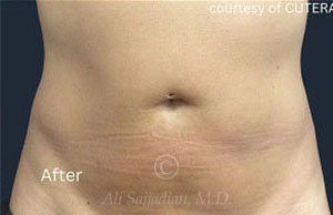 after truSculpt ID view female patient