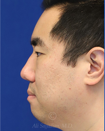 Have You Always Wanted a Chiseled Face? Learn About Buccal Fat Removal - Ali Sajjadian, MD