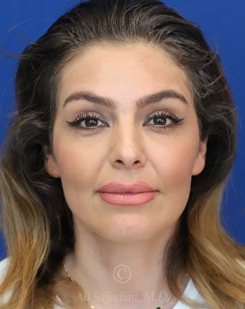before chin filler front view female patient case 18652