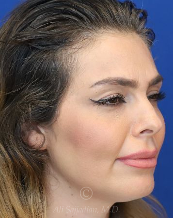before chin filler left view female patient case 18652
