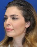 before chin filler right view female patient case 18652