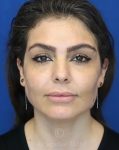 after chin filler front view female patient case 18652
