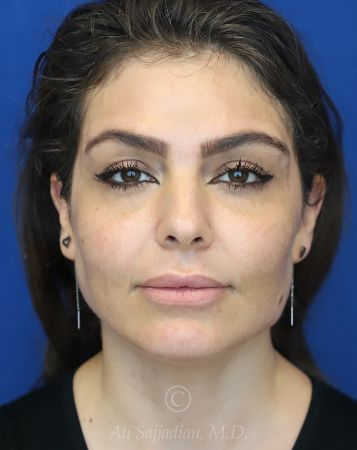 after chin filler front view female patient case 18652