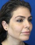 after chin filler right view female patient case 18652
